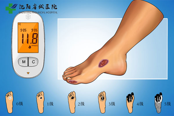 沈阳省城医院糖尿病中心：糖尿病人群怎么合理控制饮食